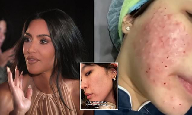 Kim Kardashian Reveals She Had Salmon Sperm Injected Into Her Face