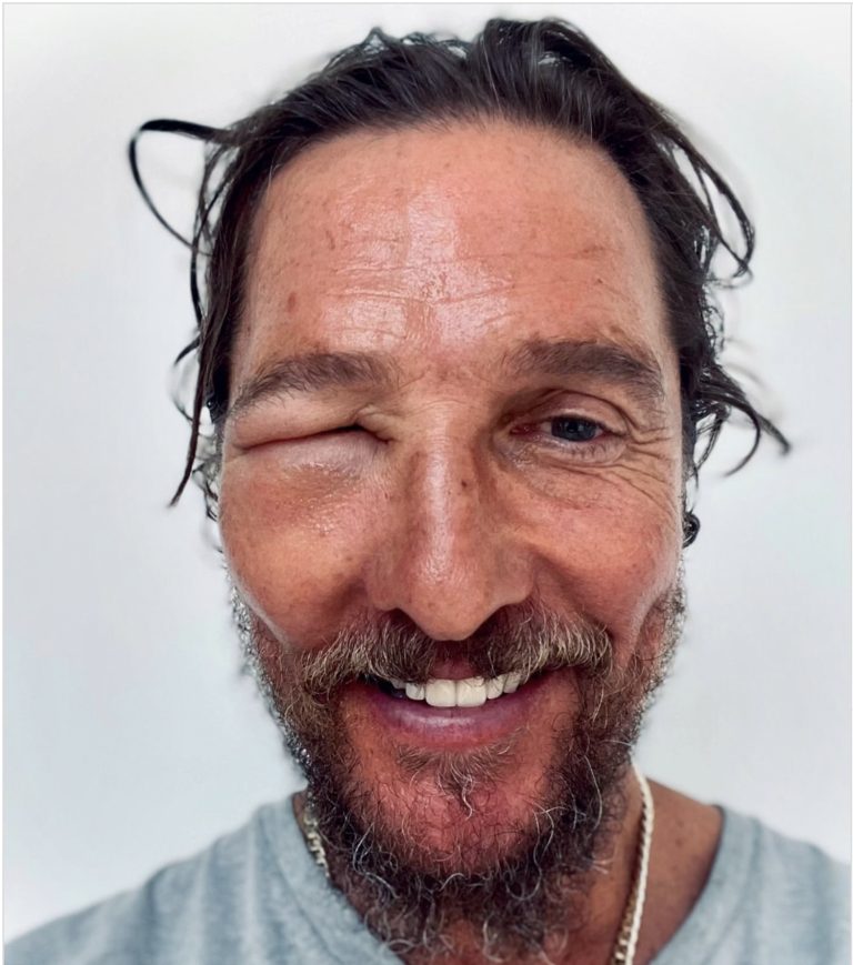 Matthew McConaughey Posts Shocking Bee Sting Photo