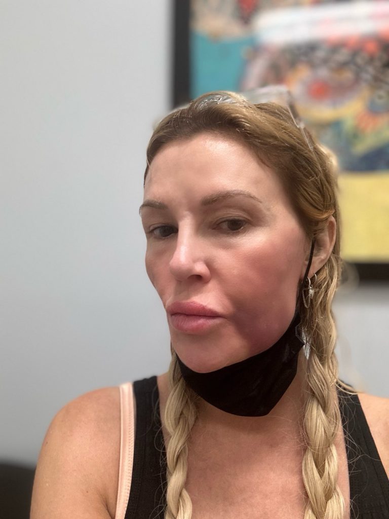 Brandi Glanville Blames Bravo for Disfigured Face